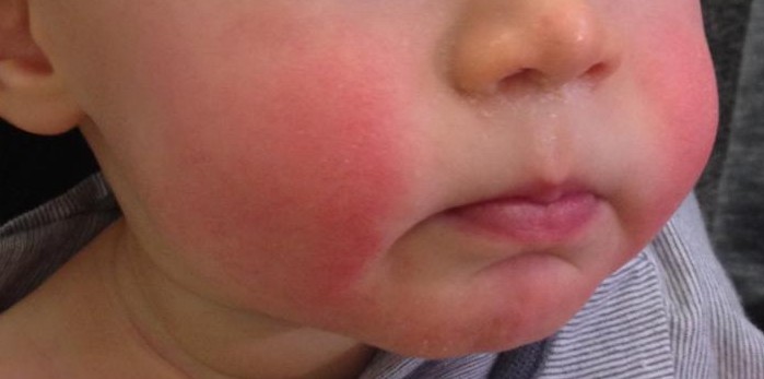 Dr. Yeung Ho Hong(楊浩康) explains Slapped Cheek Syndrome (Erythema Infectiosum)